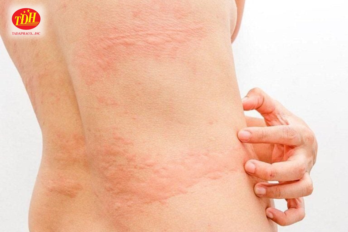 Tác dụng phụ do sử dụng TPCN gan quá liều